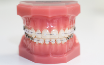 How Long Do Braces Take?