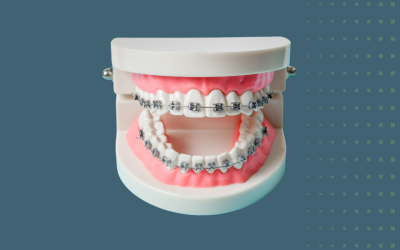 Cost of Braces in Boca Raton