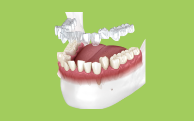 Boca Raton’s #1 Invisalign Orthodontics