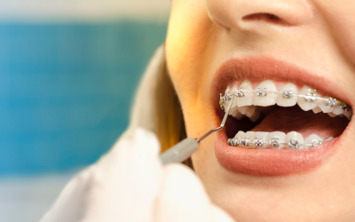 Braces for Adults in Boca Raton